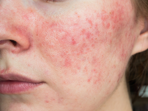 Papulopustular,Rosacea,,Close-up,Of,The,Patient's,Cheek
