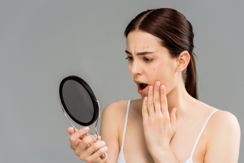 Shocked,Young,Woman,With,Acne,On,Face,Looking,At,Mirror